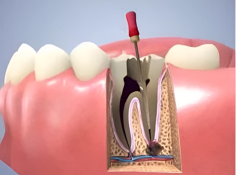 Single Sitting Root Canal Treatment(RCT)